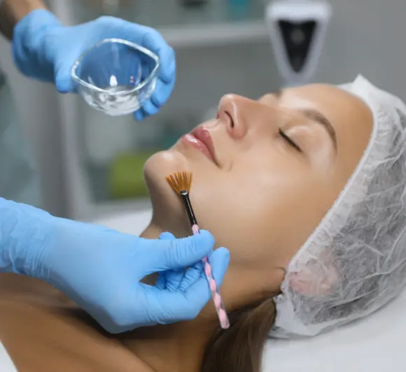 Chemical Peels